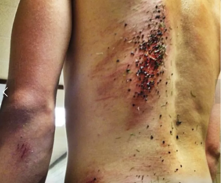 turf burns